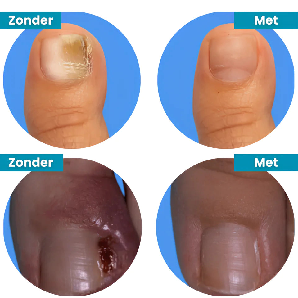 Novanail™ | Aantrekkelijke nagels in 14 dagen