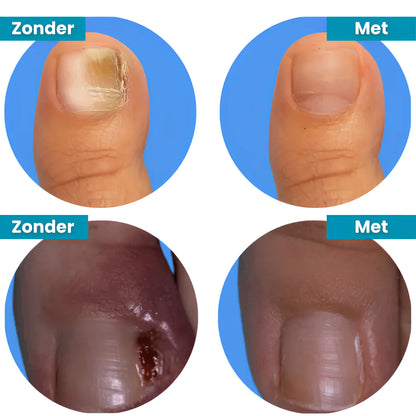 Novanail™ | Aantrekkelijke nagels in 14 dagen